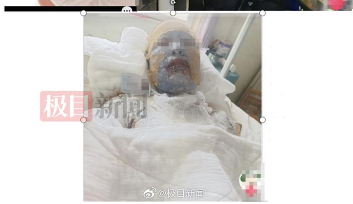 妻子遇液化气泄漏爆炸全身超九成烧伤，丈夫全网求助：“不敢想象她该有多疼”