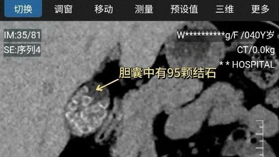 女子体内塞满近百颗结石，医生震惊：这习惯很多人都有！