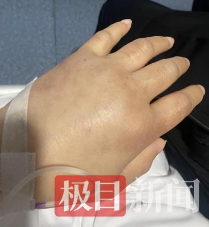 女子浑身水肿肾功能衰竭，原来是患上这个疾病
