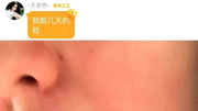 26岁演员王楚然求助荨麻疹疗法，网友：太有共鸣，崩溃！