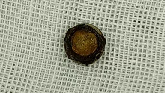 幼童鼻腔惊现纽扣电池，医生提醒：这类“迷你凶器”常见又危险