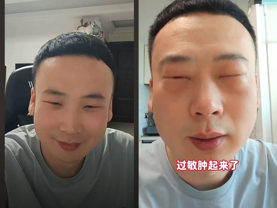 吃蚕蛹后眼睛肿如“奥特曼”？医生：异性蛋白过敏，重症或危及生命